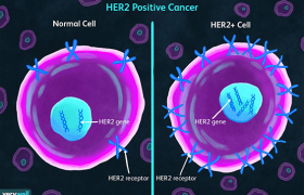 Her2 pozitif İleri evre meme kanserinin güncel tedavisi ? Akıllı ilaç kemoterapi beraber uygulanır mı? Akıllı füze - hedefe atılan füze tedavisi nelerdelir ?